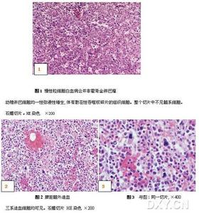 （图）浆细胞白血病