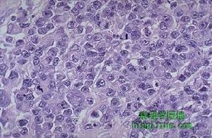 （图）此恶性淋巴细胞体积大、有较丰富的细胞浆，核圆型或卵圆型，核仁明显，偶有核分裂像，诊断为弥漫大B细胞淋巴瘤(也称免疫母细胞淋巴瘤）