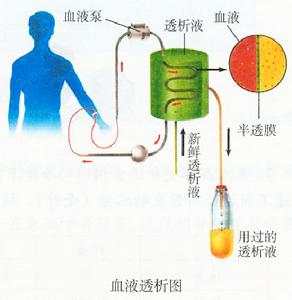 血液透析图